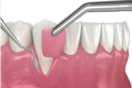 Enxerto-de-gengiva-para-recobrimento-de-raiz-exposta-por-causa-de-sensibilidade-no-dente