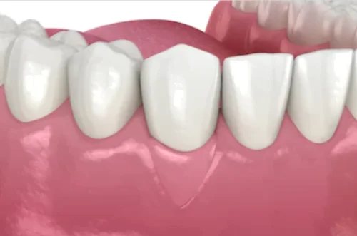 Enxerto-de-gengiva-posicionado-para-cobertura-de-raiz-exposta-que-deixava-o-dente-com-sensibilidade