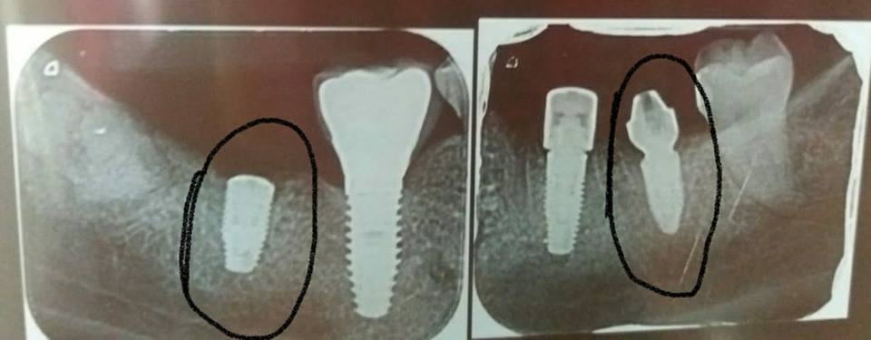 Implantes dentários na região de molares