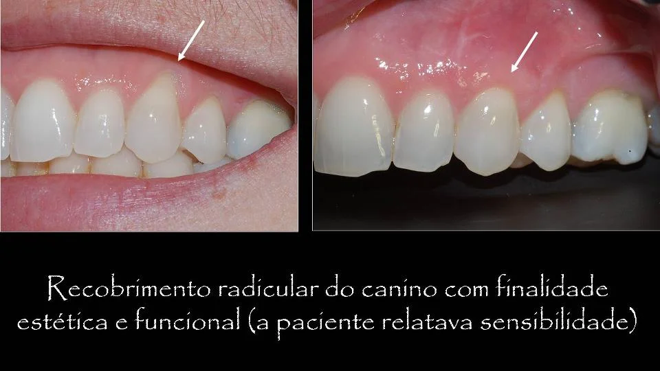 enxerto-de-gengiva-antes-e-depois