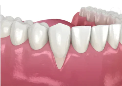 Retração-gengival-exposição-da-raiz-sensibilidade-no-dente