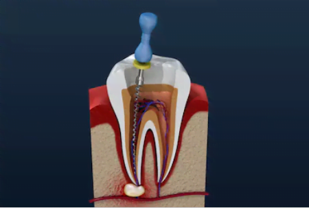 Endodontia Tratamento De Canal O Doutor Responde