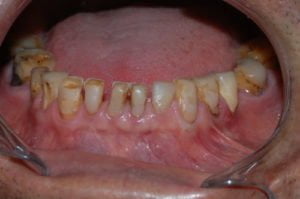 Paciente com bruxismo ou desgaste excessivo nos dentes causado pelo rangimento