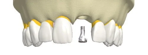 Localização dos implantes metálicos inseridos na maxila e na