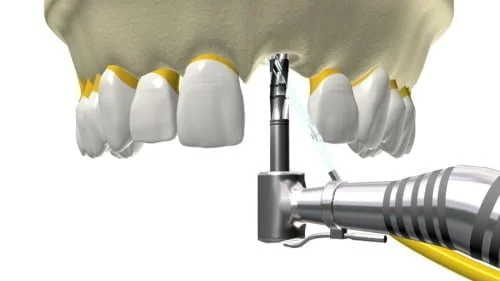 Localização dos implantes metálicos inseridos na maxila e na