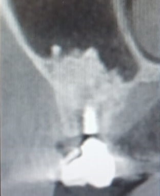 dolore all'impianto dentale cono morse nella regione dell'innesto dopo mesi