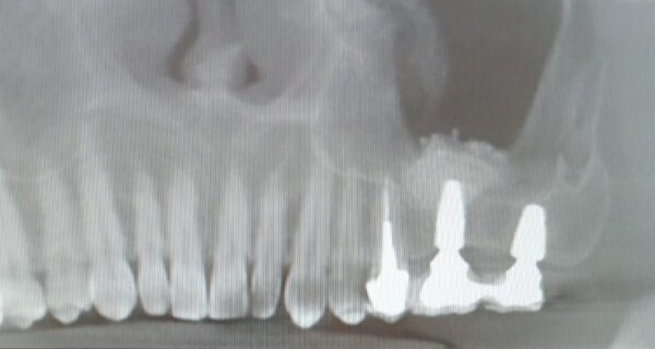 dolore da impianto dentale dopo mesi