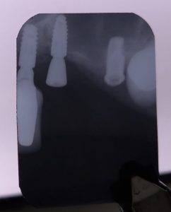 Rx-com-cicatrizador-do-implant-straumann-bone-level-3.3