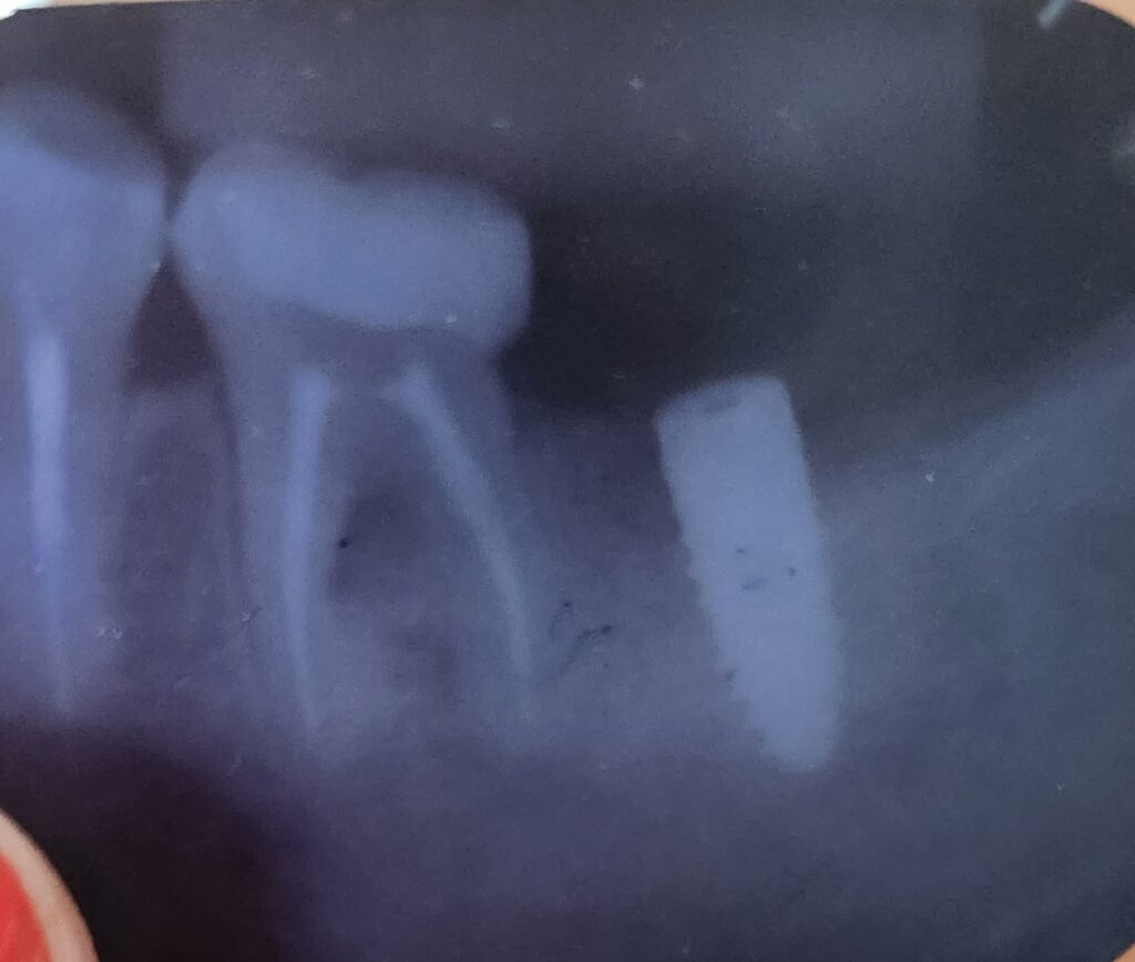 dor no implante dentário e no ouvido